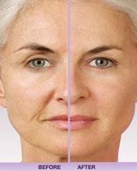 Juvederm CLCI Procedures of Cosmetic Laser Center of Irvine 15775 Laguna Canyon Rd. Suite 270 - Photo 8 of 17