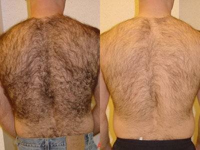 Laser Hair Removal CLCI Procedures of Cosmetic Laser Center of Irvine 15775 Laguna Canyon Rd. Suite 270 - Photo 7 of 17