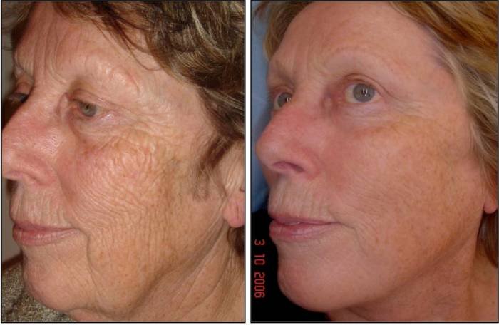 cO2 Fractionated Resurfacing Laser CLCI Procedures of Cosmetic Laser Center of Irvine 15775 Laguna Canyon Rd. Suite 270 - Photo 5 of 17