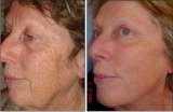 cO2 Fractionated Resurfacing Laser, Cosmetic Laser Center of Irvine, Irvine