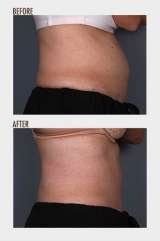 LIPOSONIX, Cosmetic Laser Center of Irvine, Irvine