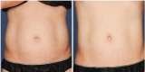LIPOSONIX, Cosmetic Laser Center of Irvine, Irvine