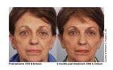 cO2 Fractionated Resurfacing Laser, Cosmetic Laser Center of Irvine, Irvine