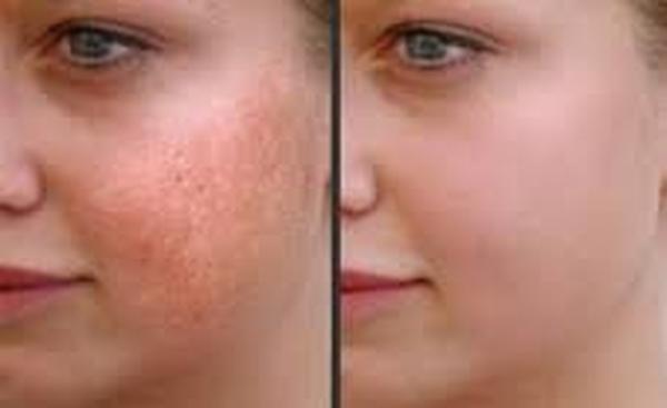 Profile Photos of Pigmentation Removal 37 Pocket-1  Jasola Nr Apollo Hospital New Delhi-110025 - Photo 3 of 4