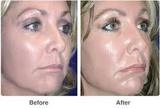  Pigmentation Removal 37 Pocket-1  Jasola Nr Apollo Hospital New Delhi-110025 