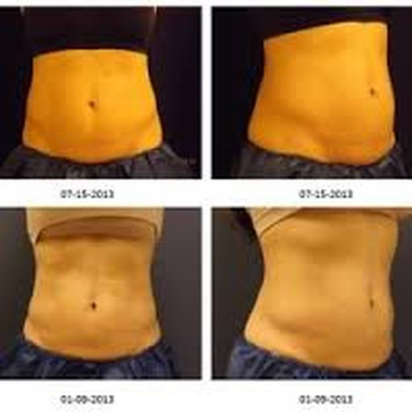  Profile Photos of Coolsculpting in India 37 Pocket-1  Jasola Nr Apollo Hospital New Delhi-110025 - Photo 2 of 4