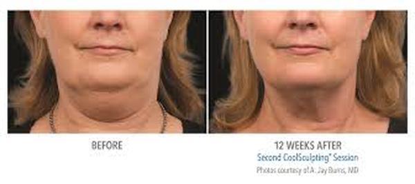  Profile Photos of Coolsculpting in India 37 Pocket-1  Jasola Nr Apollo Hospital New Delhi-110025 - Photo 3 of 4