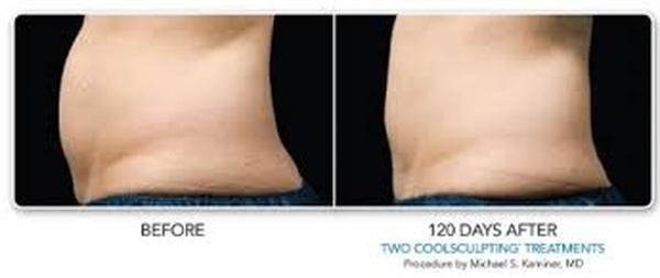  Profile Photos of Coolsculpting in India 37 Pocket-1  Jasola Nr Apollo Hospital New Delhi-110025 - Photo 4 of 4