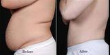 Coolsculpting in India, Delhi