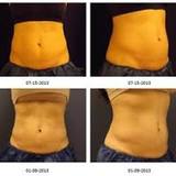 Coolsculpting in India, Delhi