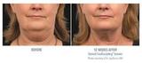 Coolsculpting in India, Delhi