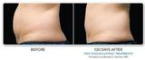 Coolsculpting in India, Delhi