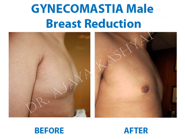  Profile Photos of Best  Gynecomastia Surgery in India 13 A Palam Marg, Vasant Vihar - Photo 2 of 3
