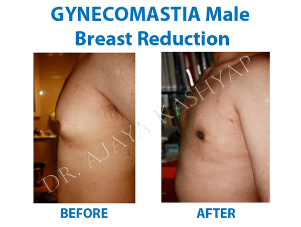  Profile Photos of Best  Gynecomastia Surgery in India 13 A Palam Marg, Vasant Vihar - Photo 3 of 3