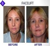 Face Plastic Surgery Cost in Delhi, Delhi