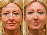 Face Plastic Surgery Cost in Delhi, Delhi