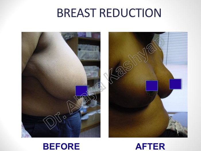 Breast Reduction/Lift Surgery in Delhi, India Breast Surgery Before After Pictures of Best Breast Surgeon in Delhi by Dr Ajaya Kashyap 13A, Palam Marg, Vasant Vihar - Photo 2 of 8