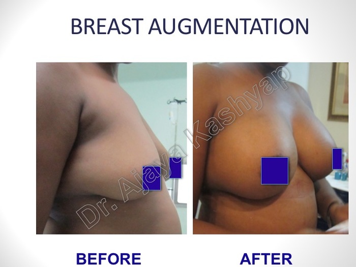 Breast Augmentation/Implants Surgery in Delhi, India Breast Surgery Before After Pictures of Best Breast Surgeon in Delhi by Dr Ajaya Kashyap 13A, Palam Marg, Vasant Vihar - Photo 4 of 8