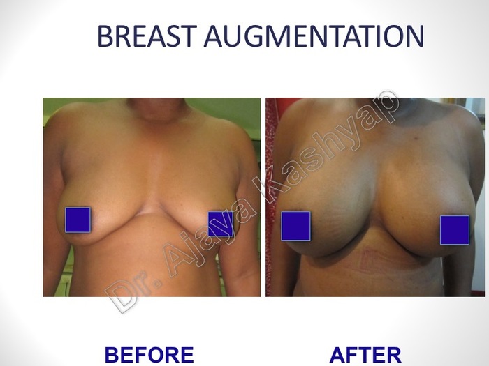 Breast Augmentation/Implants Surgery in Delhi, India Breast Surgery Before After Pictures of Best Breast Surgeon in Delhi by Dr Ajaya Kashyap 13A, Palam Marg, Vasant Vihar - Photo 5 of 8