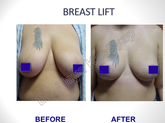 Breast Lift Surgery in Delhi, India Breast Surgery Before After Pictures of Best Breast Surgeon in Delhi by Dr Ajaya Kashyap 13A, Palam Marg, Vasant Vihar - Photo 7 of 8