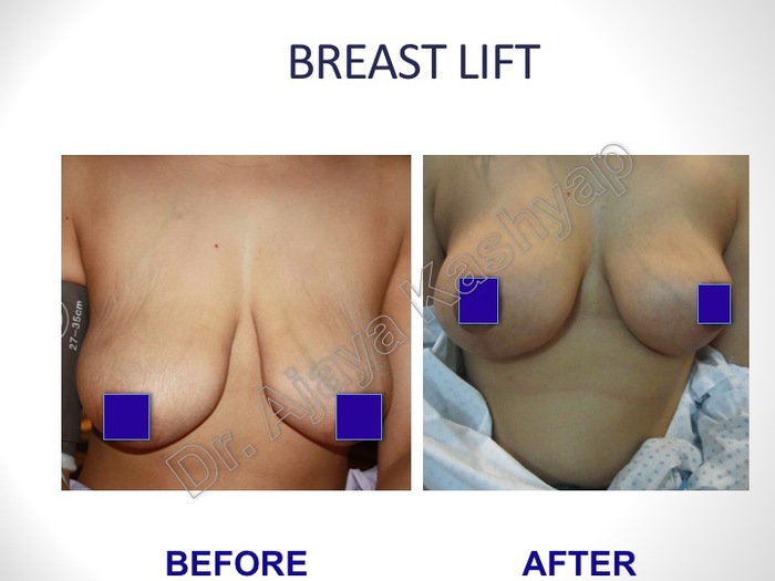 Breast Lift Surgery in Delhi, India Breast Surgery Before After Pictures of Best Breast Surgeon in Delhi by Dr Ajaya Kashyap 13A, Palam Marg, Vasant Vihar - Photo 8 of 8