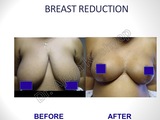 Breast Reduction/Lift Surgery in Delhi, India Best Breast Surgeon in Delhi by Dr Ajaya Kashyap 13A, Palam Marg, Vasant Vihar 