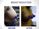 Breast Reduction/Lift Surgery in Delhi, India Best Breast Surgeon in Delhi by Dr Ajaya Kashyap 13A, Palam Marg, Vasant Vihar 