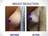 Breast Reduction/Lift Surgery in Delhi, India Best Breast Surgeon in Delhi by Dr Ajaya Kashyap 13A, Palam Marg, Vasant Vihar 