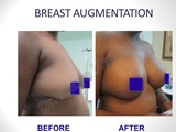 Breast Augmentation/Implants Surgery in Delhi, India Best Breast Surgeon in Delhi by Dr Ajaya Kashyap 13A, Palam Marg, Vasant Vihar 