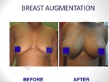 Breast Augmentation/Implants Surgery in Delhi, India, Best Breast Surgeon in Delhi by Dr Ajaya Kashyap, New Delhi