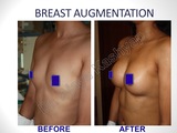 Breast Augmentation/Implants Surgery in Delhi, India, Best Breast Surgeon in Delhi by Dr Ajaya Kashyap, New Delhi