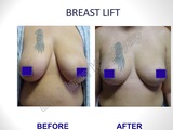Breast Lift Surgery in Delhi, India, Best Breast Surgeon in Delhi by Dr Ajaya Kashyap, New Delhi
