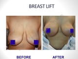 Breast Lift Surgery in Delhi, India, Best Breast Surgeon in Delhi by Dr Ajaya Kashyap, New Delhi