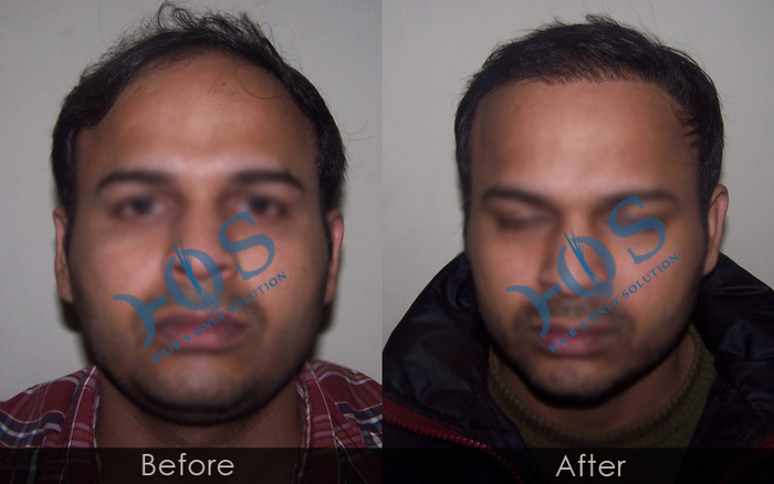  New Album of Hos Hair Clinic A-757, Tulsi Marg, Sec 19 - Photo 5 of 9