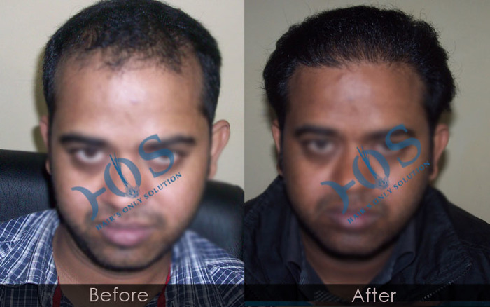 New Album of Hos Hair Clinic A-757, Tulsi Marg, Sec 19 - Photo 6 of 9