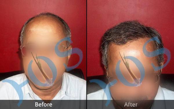  Profile Photos of Hos Hair Clinic A-757, Tulsi Marg, Sec 19 - Photo 1 of 2