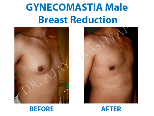 Gynecomastia Surgery in Delhi | Male Breast Reduction in Delhi,, India New Album of Best Gynecomastia Surgeon in Delhi 13A PALAM MARG, VASANT VIHAR, NEW DELHI-110057, INDIA - Photo 3 of 5 Gynecomastia Surgery in Delhi | Male Breast Reduction in Delhi,, India New Album of Best Gynecomastia Surgeon in Delhi 13A PALAM MARG, VASANT VIHAR, NEW DELHI-110057, INDIA - Photo 3 of 5