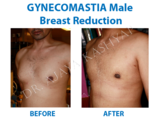 Gynecomastia Surgery in Delhi | Male Breast Reduction in Delhi,, India, Best Gynecomastia Surgeon in Delhi, New Delhi