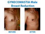 Gynecomastia Surgery in Delhi | Male Breast Reduction in Delhi,, India, Best Gynecomastia Surgeon in Delhi, New Delhi