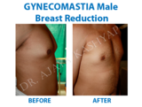 Gynecomastia Surgery in Delhi | Male Breast Reduction in Delhi,, India, Best Gynecomastia Surgeon in Delhi, New Delhi