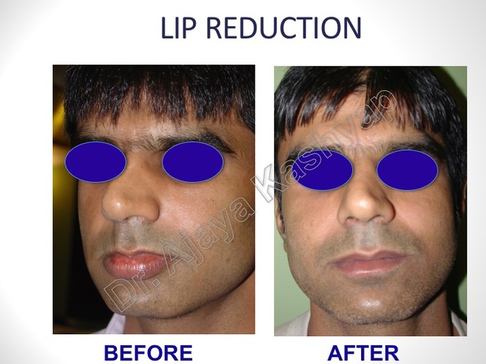 Lip Reduction Surgery in Delhi Profile Photos of Lip Reduction Surgery in Delhi 13A PALAM MARG, VASANT VIHAR - Photo 2 of 2