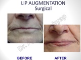 Lip Augmentation Surgery in Delhi, Lip Reduction Surgery in Delhi, NEW DELHI