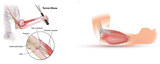 Tennis Elbow: Causes and Prevention Maya Physio & Health Inc. 10066 Bayview Ave #2 