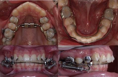  Profile Photos of 32PEARLS IMPLANT & ORTHODONTIC DENTAL HOSPITAL SANTOKHGARH MDR 39;Near  New Bus Stand - Photo 7 of 7