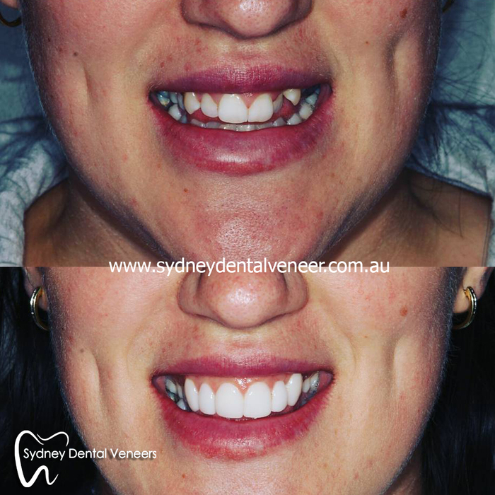  Before and After Photos of Sydney Dental Veneer 302/70 Pitt St - Photo 1 of 6