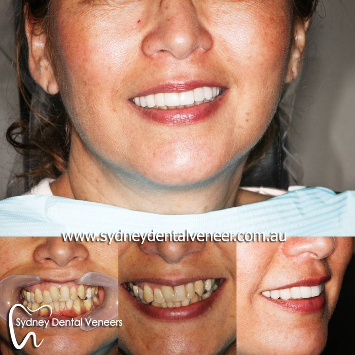 1 year review of Invisalign and veneer smile makeover. <br />
#smilemakeover #dentalveneers #invisalign #cosmeticdentist #cosmeticdentistry #instasmile #smile Before and After Photos of Sydney Dental Veneer 302/70 Pitt St - Photo 2 of 6 1 year review of Invisalign and veneer smile makeover. <br />
#smilemakeover #dentalveneers #invisalign #cosmeticdentist #cosmeticdentistry #instasmile #smile Before and After Photos of Sydney Dental Veneer 302/70 Pitt St - Photo 2 of 6