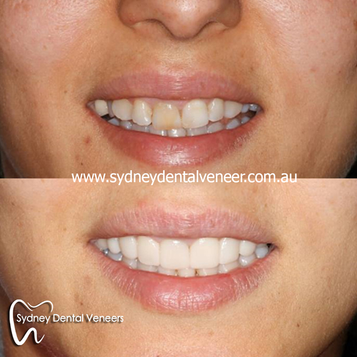 WIP. Pity the existing crowns on the left hand side means I cannot extend them to match the rest of teeth.<br />
<br />
This is just some provisionals trial smile.<br />
<br />
#smilemakeover #WIP #cosmeticdentist #cosmeticdentistry #dentalveneers Before and After Photos of Sydney Dental Veneer 302/70 Pitt St - Photo 3 of 6 WIP. Pity the existing crowns on the left hand side means I cannot extend them to match the rest of teeth.<br />
<br />
This is just some provisionals trial smile.<br />
<br />
#smilemakeover #WIP #cosmeticdentist #cosmeticdentistry #dentalveneers Before and After Photos of Sydney Dental Veneer 302/70 Pitt St - Photo 3 of 6