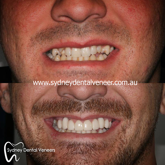 Poor gentleman didn't want to smile for us before my work. Now he smiles too wide. A good problem to have. <br />
1.5 year review. Good to see he's enjoying them.<br />
<br />
#smilemakeover #cosmeticdentistry #cosmeticdentist #dentalveneers #smile #instasmile Before and After Photos of Sydney Dental Veneer 302/70 Pitt St - Photo 4 of 6 Poor gentleman didn't want to smile for us before my work. Now he smiles too wide. A good problem to have. <br />
1.5 year review. Good to see he's enjoying them.<br />
<br />
#smilemakeover #cosmeticdentistry #cosmeticdentist #dentalveneers #smile #instasmile Before and After Photos of Sydney Dental Veneer 302/70 Pitt St - Photo 4 of 6