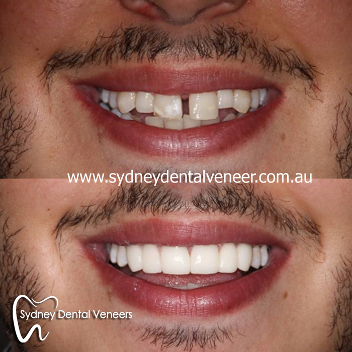 Poor gentleman didn't want to smile for us before my work. Now he smiles too wide. A good problem to have. <br />
1.5 year review. Good to see he's enjoying them.<br />
<br />
#smilemakeover #cosmeticdentistry #cosmeticdentist #dentalveneers #smile #instasmile Before and After Photos of Sydney Dental Veneer 302/70 Pitt St - Photo 5 of 6 Poor gentleman didn't want to smile for us before my work. Now he smiles too wide. A good problem to have. <br />
1.5 year review. Good to see he's enjoying them.<br />
<br />
#smilemakeover #cosmeticdentistry #cosmeticdentist #dentalveneers #smile #instasmile Before and After Photos of Sydney Dental Veneer 302/70 Pitt St - Photo 5 of 6