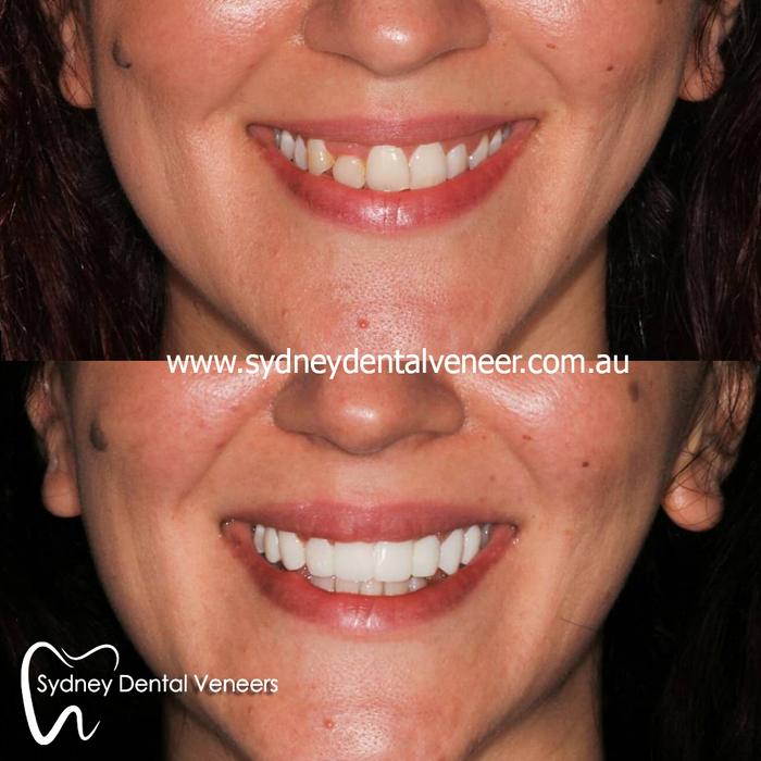 Midline shift disguise and masking asymmetry. Surprisingly challenging but we have some success.<br />
<br />
#smilemakeover<br />
#dentalveneers<br />
#cosmeticdentist #cosmeticdentistry #emax Before and After Photos of Sydney Dental Veneer 302/70 Pitt St - Photo 6 of 6 Midline shift disguise and masking asymmetry. Surprisingly challenging but we have some success.<br />
<br />
#smilemakeover<br />
#dentalveneers<br />
#cosmeticdentist #cosmeticdentistry #emax Before and After Photos of Sydney Dental Veneer 302/70 Pitt St - Photo 6 of 6